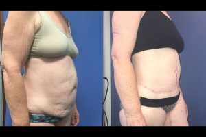 Dr Hanikeri's patient before and after body contouring surgery 01